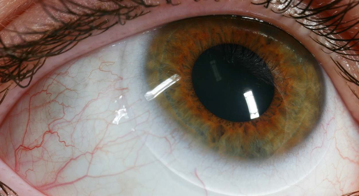 El desprendimiento de retina es una afección ocular grave y ocurre cuando la retinase separa de su posición normal. En este artículo te contamos los síntomas, causas y tratamientos para el desprendimiento de retina.