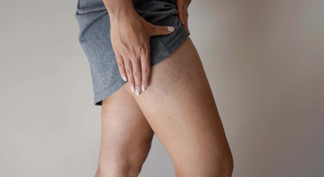 Las varices pueden operarse, pero no siempre es la mejor opción. Descubre los síntomas, los tratamientos y cuándo se recomienda la cirugía.