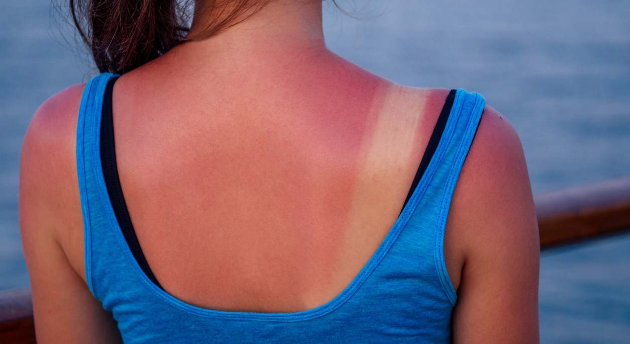 una mujer muestra quemaduras en su espalda provocadas por el sol