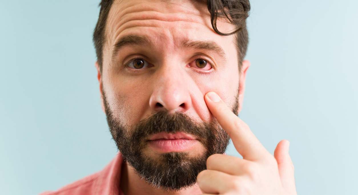 ¿Qué es la queratitis y cuáles son sus síntomas? Descúbrelo y conoce los tratamientos que se pueden emplear para enfrentar esta afección ocular.