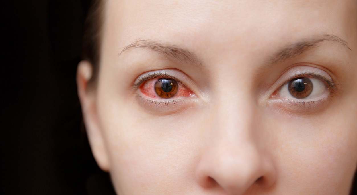 La irritación ocular es cada vez un problema más común debido a la mayor exposición a las pantallas. Te contamos  remedios efectivos que alivian este síntoma fácil y rápidamente.
