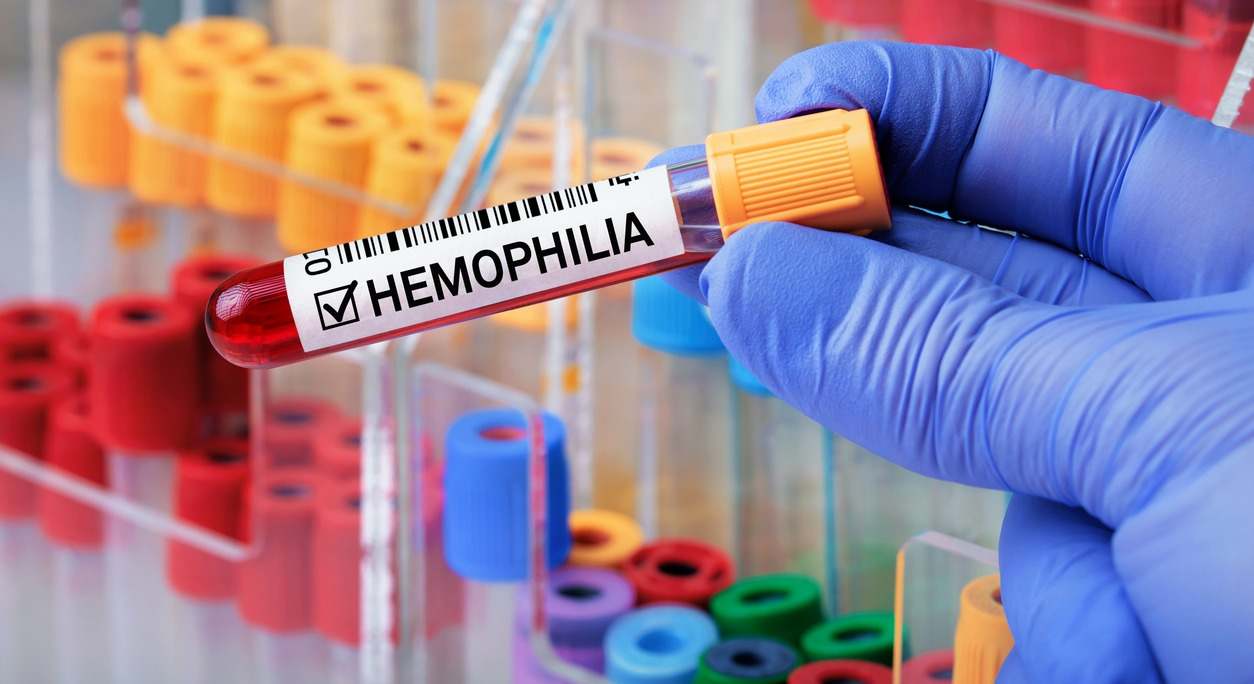 La hemofilia es un trastorno coagulante poco habitual. Descubre en este artículo que lo causa y cuáles son sus síntomas.