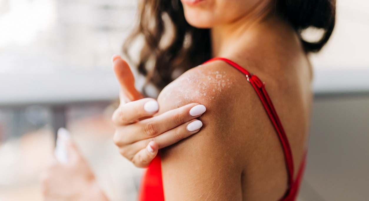 El callo solar es una creencia errónea según la cual tomar el sol sin protección ayuda a fortalecer la piel. Descubre por qué peligroso y cómo evitarlo.