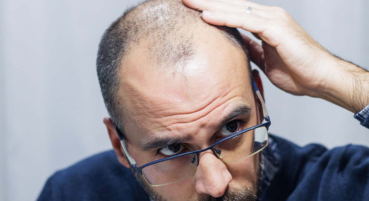 La dieta es un factor muy importante para evitar la alopecia y poder frenar la caída del pelo. Descubre en este artículos los alimentos recomendados.