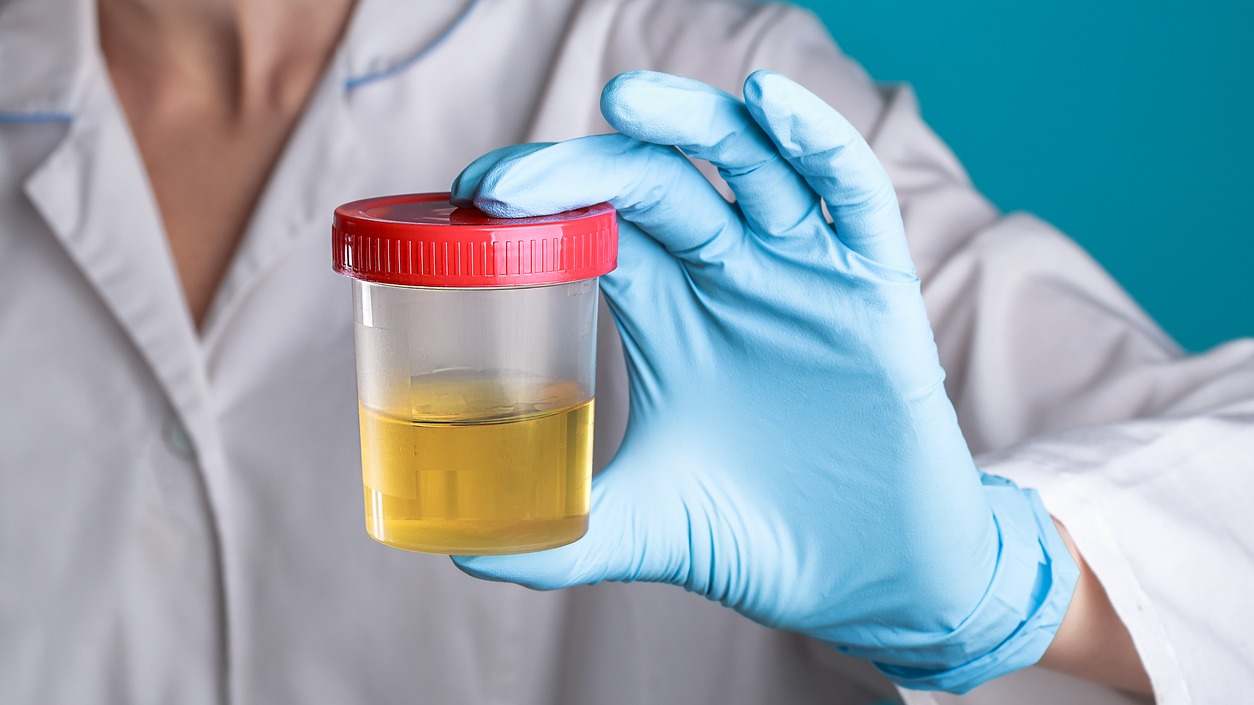 orina_pis_color_amarillo_muestra