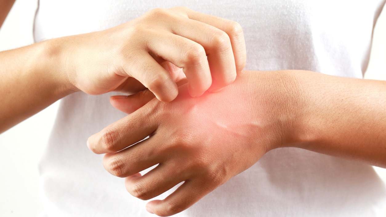 Lo que necesitas saber sobre la dermatitis atópica o eccema: Qué es, cuáles son sus síntomas y causas y cómo se trata