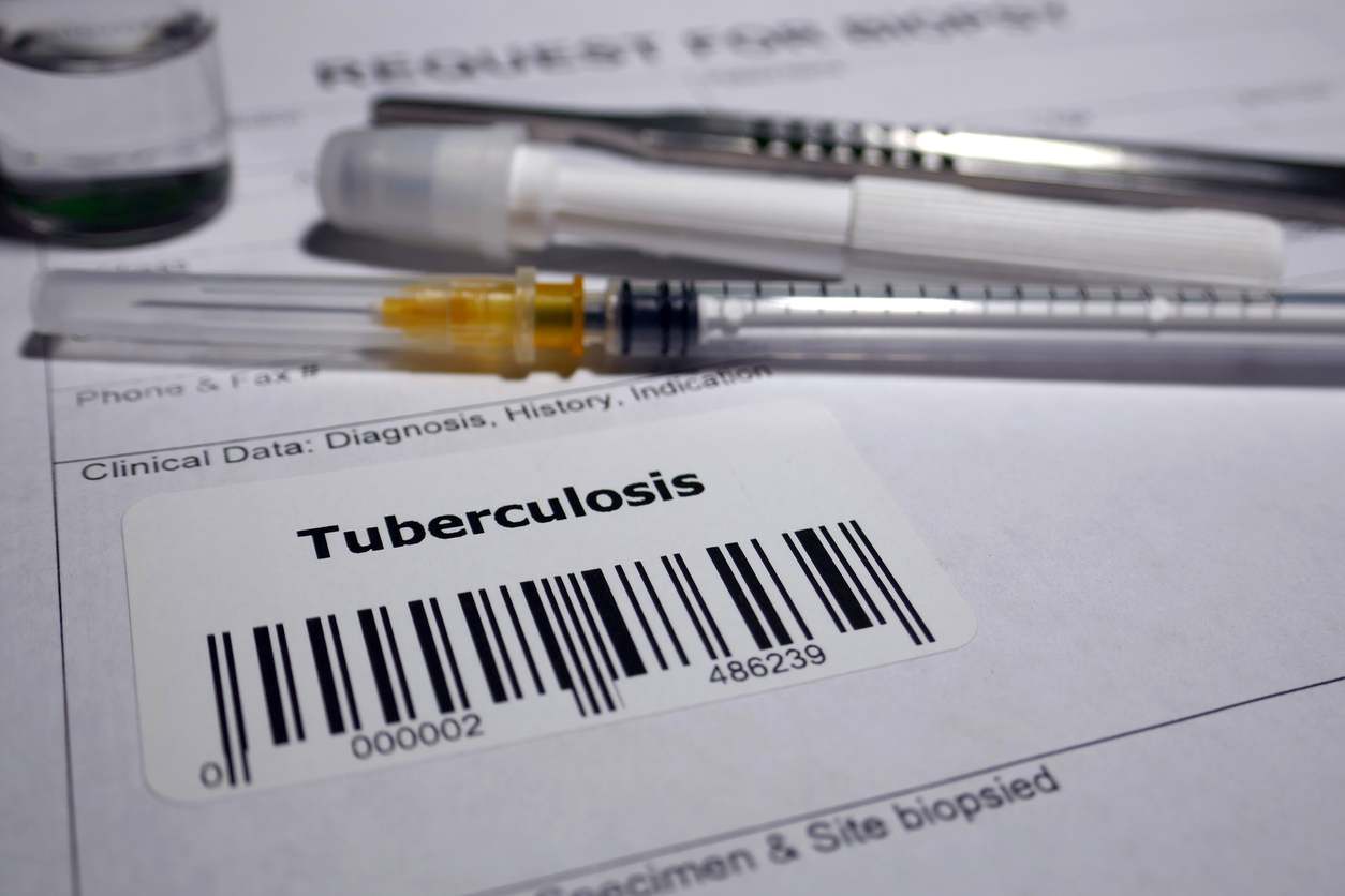 La tuberculosis es una enfermedad infecciosa que afecta a los pulmones. Descubre que es un brote de tuberculosis en este artículo.