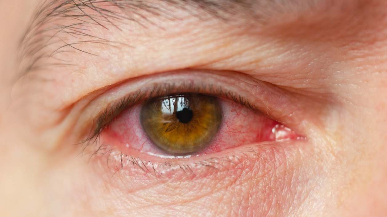La uveítis es la inflamación de la capa media del ojo que afecta a varias partes del ojo. En este artículo hablamos de la uveítis y su tratamiento.