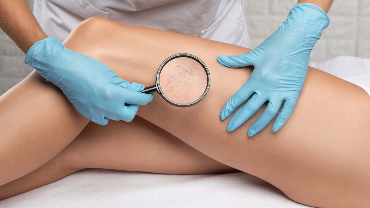 ¿Cómo quitar las varices? Descubre cuáles son los tratamientos que pueden emplearse para su eliminación y cuál es el mejor según el caso.