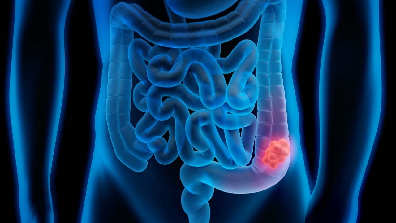 Ilustración 3D de cáncer de colon. / Foto: iStock