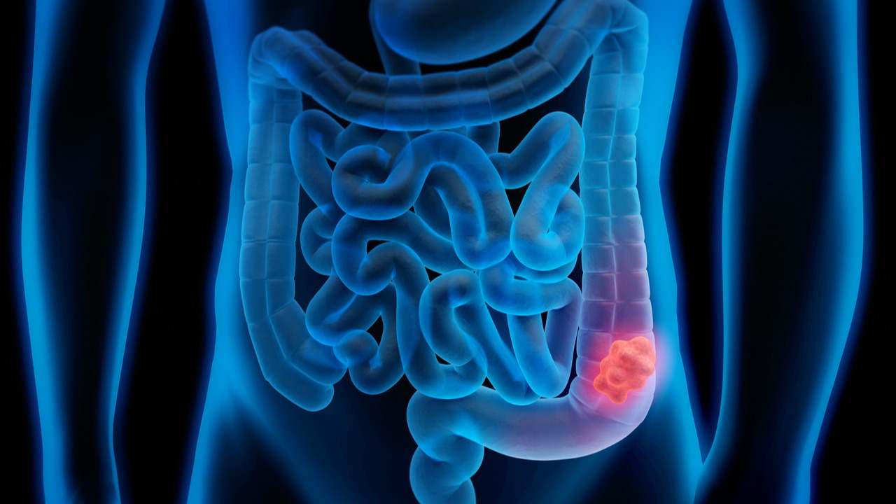 El cáncer de colon es uno de los más comunes y uno de los que presenta la tasa de curación más alta. Descubre en este artículo sus síntomas y cómo intentar prevenirlo.