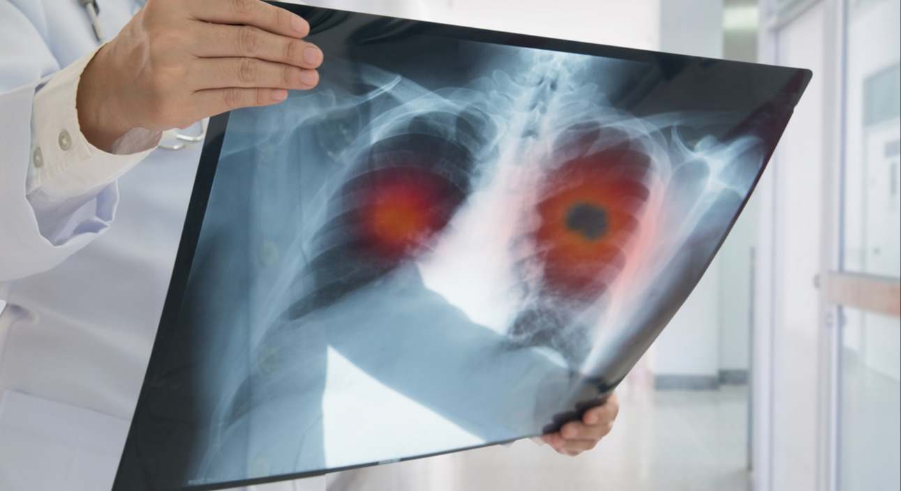 El enfisema pulmonar es una enfermedad crónica de los pulmones que se caracteriza por el daño progresivo y permanente de los alvéolos. Te contamos por qué se produce, sus síntomas y también sus posibles tratamiento.