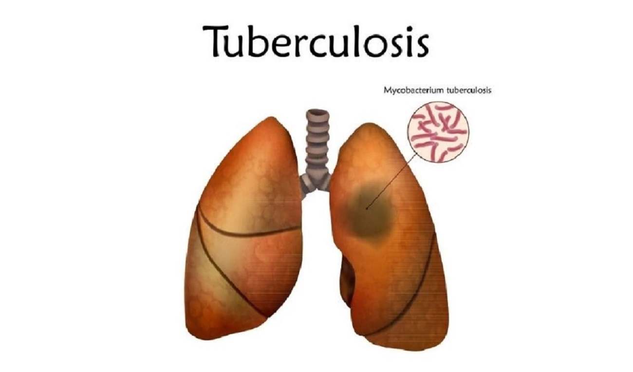tuberulosis