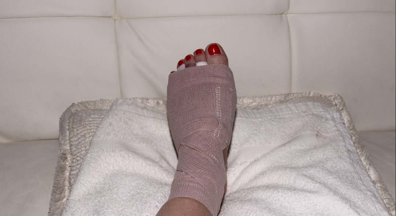Pie tras una intervención quirúrgica por un neuroma de Morton. / Foto: iStock