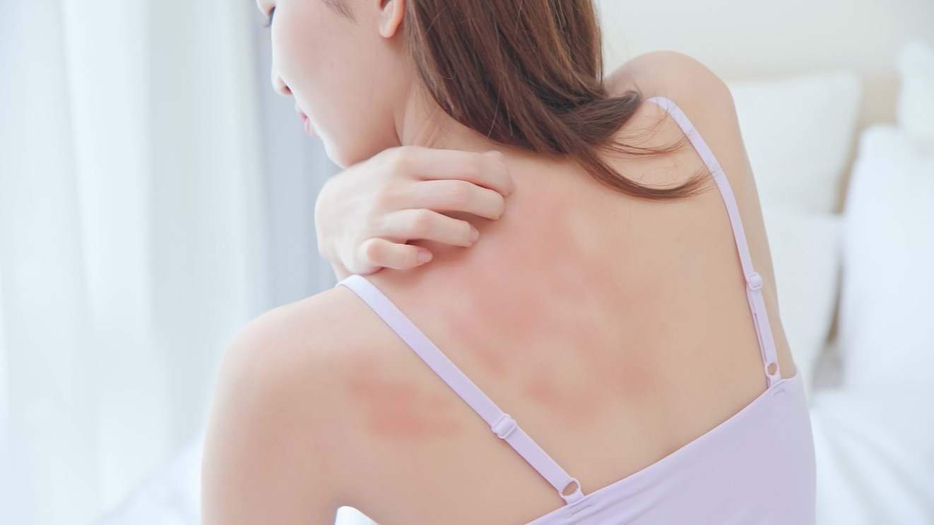 La urticaria es una afección que puede afectar gravemente la piel. Te explicamos aquí cuáles son sus síntomas y cómo puedes tratarla.