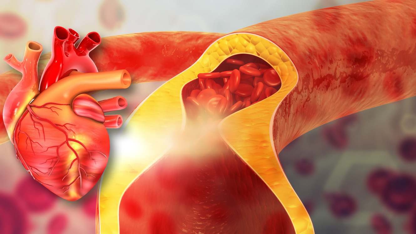 Lo que necesitas saber sobre la Arteriosclerosis: Qué es, cuáles son sus síntomas y causas y cuáles son los principales tratamientos disponibles.