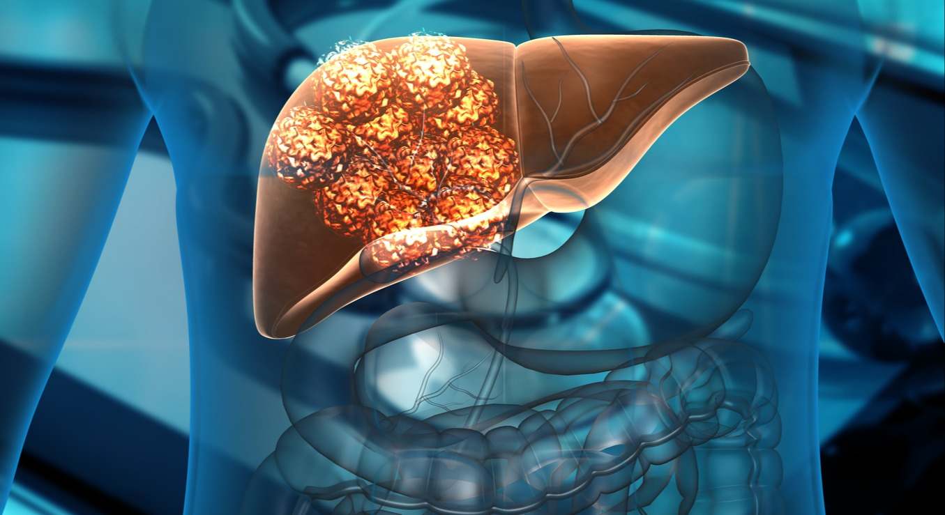 Los síntomas del cáncer ce hígado pueden no aparecer en las primeras etapas de la enfermedad y requiere de un tratamiento específico. En este artículo te contamos los síntomas y los posibles tratamientos según la etapa del cáncer.