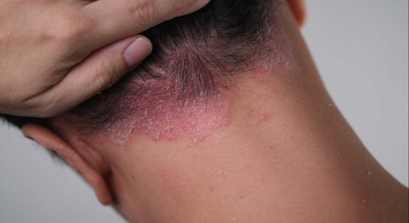 El frío empeora diferentes patologías dermatológicas