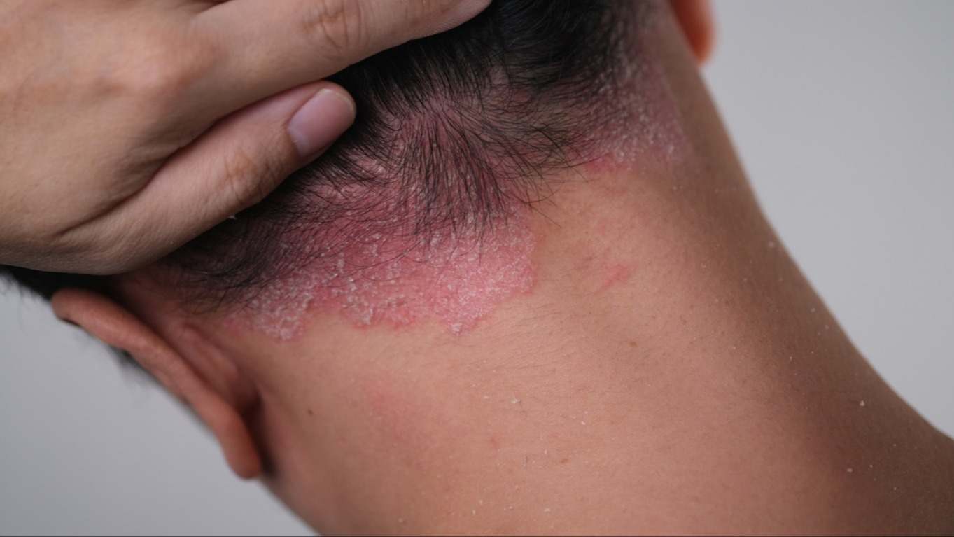 Descubre qué es la psoriasis, sus causas, y tratamientos efectivos. Conoce las opciones para aliviar los síntomas y mejora tu calidad de vida. ¿Cuándo debes consultar a un médico? Obtén respuestas clave sobre esta enfermedad cutánea común