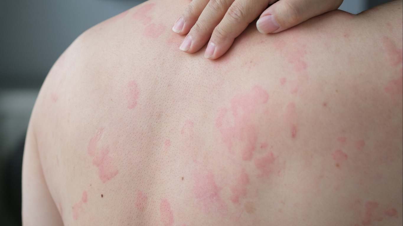Recomendaciones para evitar la Urticaria. Descubre los principales consejos para prevenir la urticaria: hábitos recomendados y precauciones