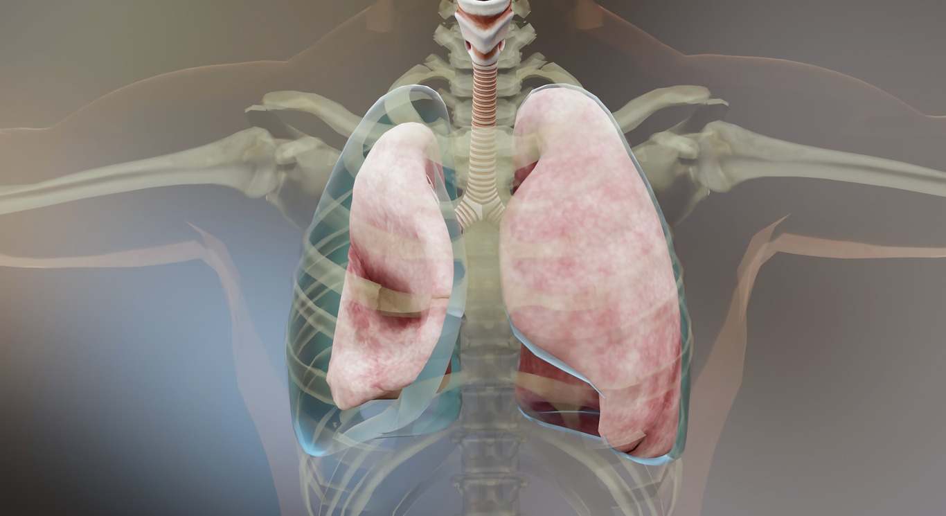 El neumotórax causa colapso pulmonar parcial o completo. Descubre qué es y cuáles son sus consecuencias en este artículo.