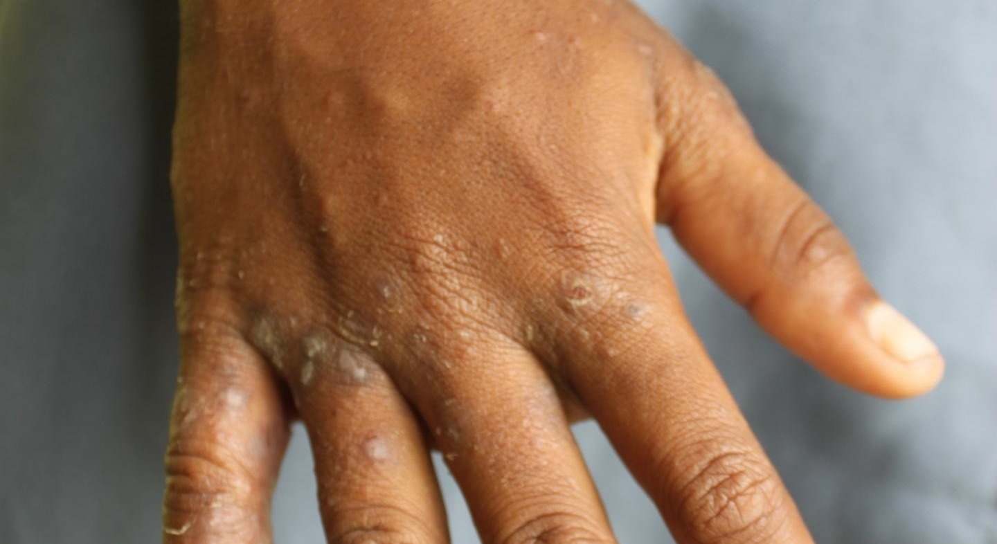 Mano infectada por sarna