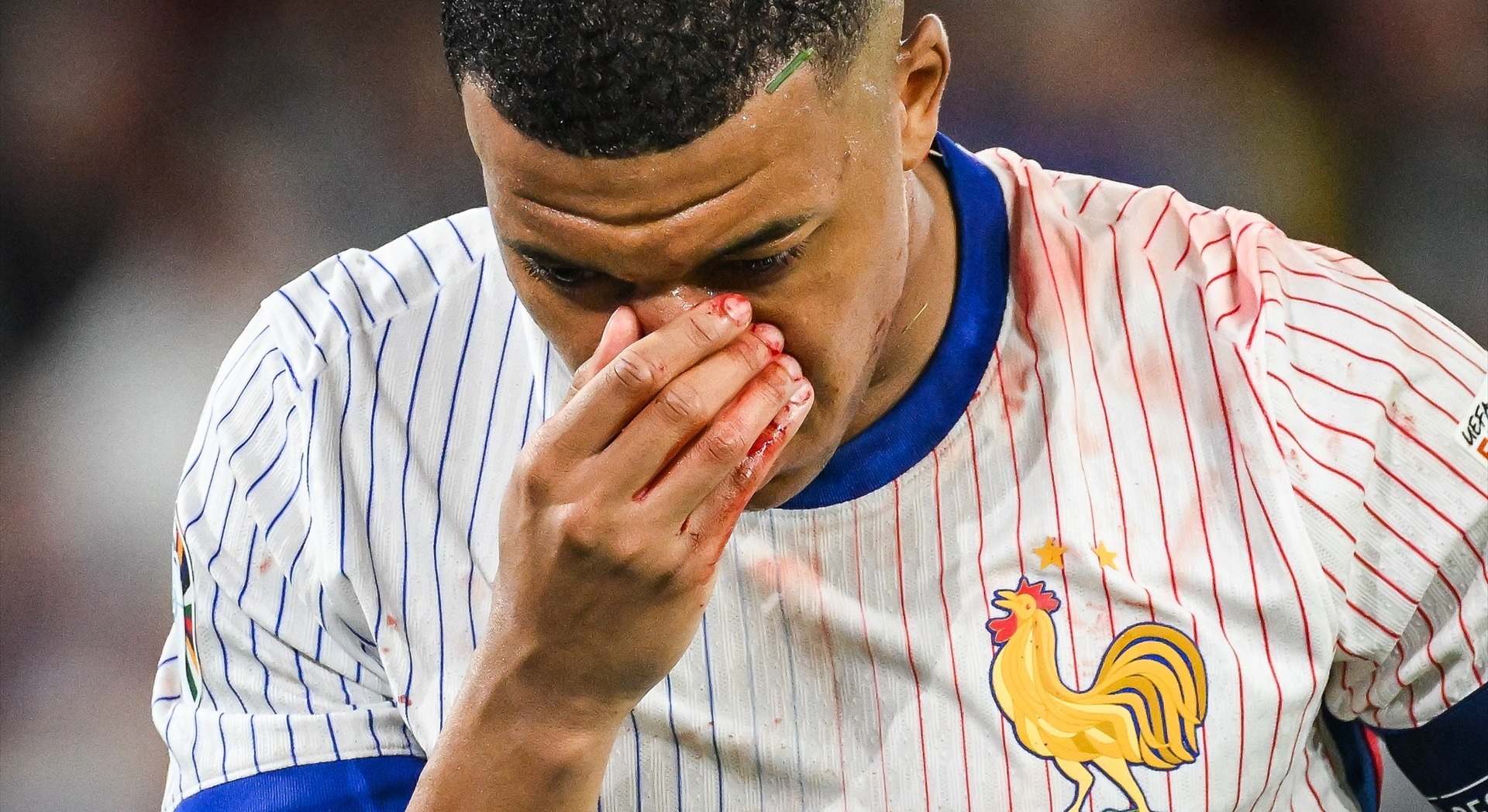 Mbappé con la nariz fracturada