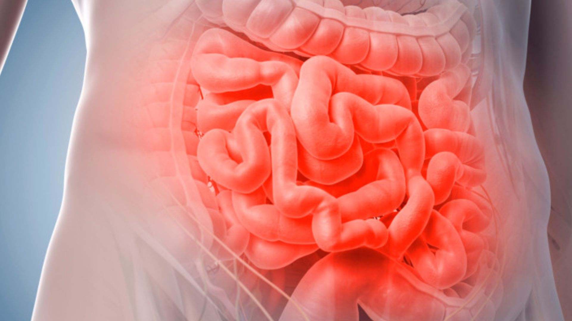 Cáncer intestinal, imagen de archivo