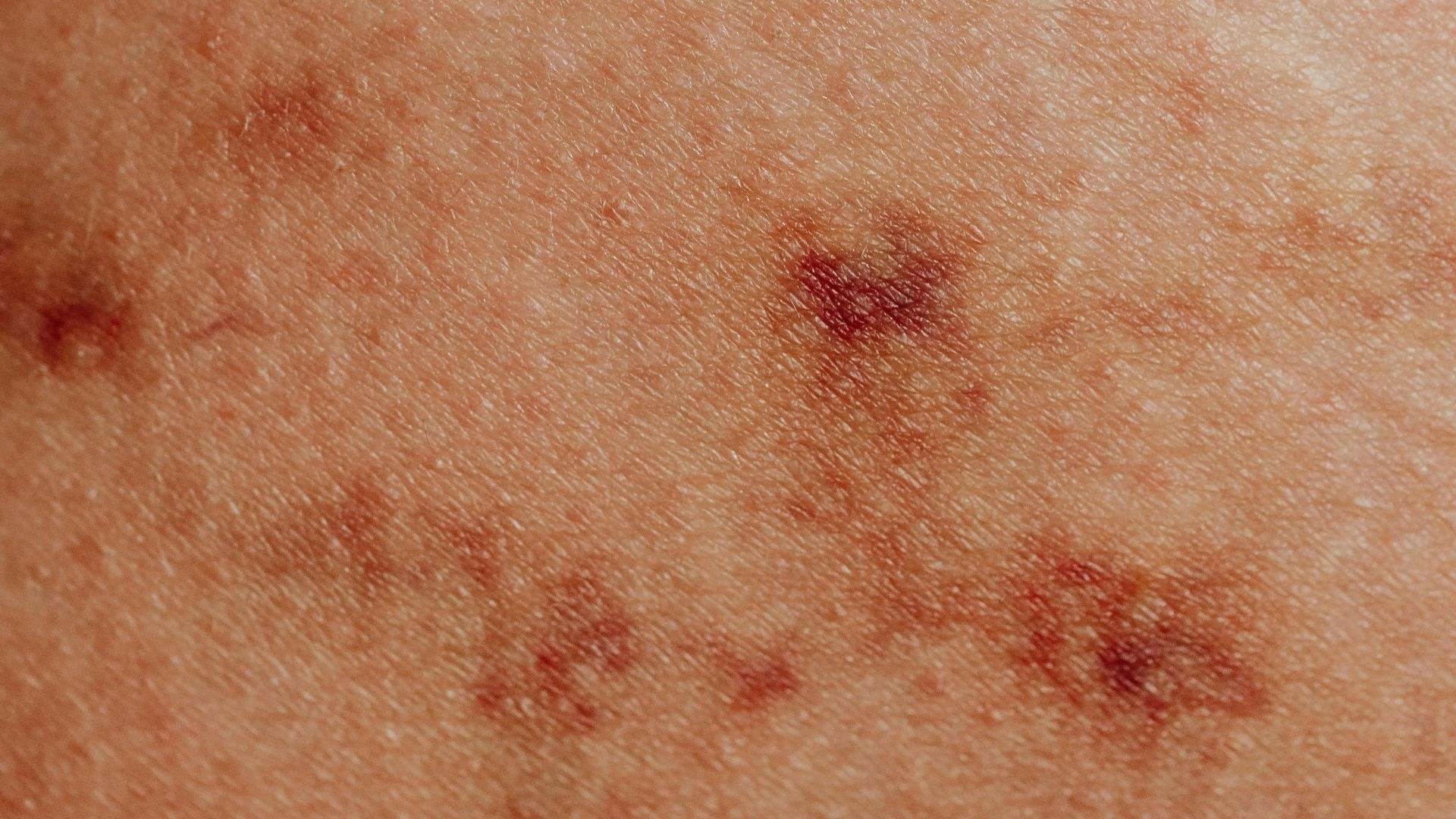 La psoriasis es una enfermedad crónica de la piel, no contagiosa