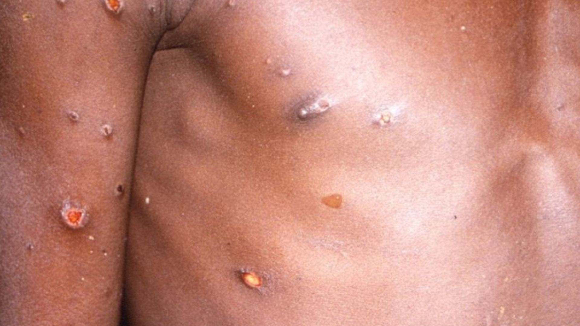 El mpox es una enfermedad causada por el virus de la viruela símica