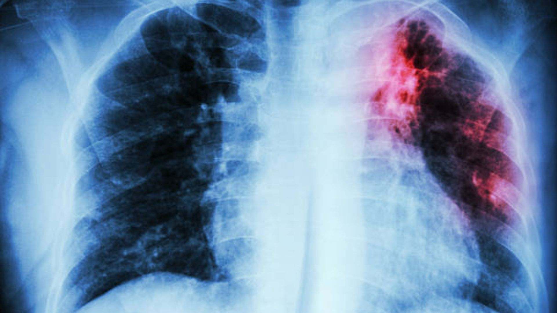 La tuberculosis es una enfermedad grave que afecta principalmente los pulmones