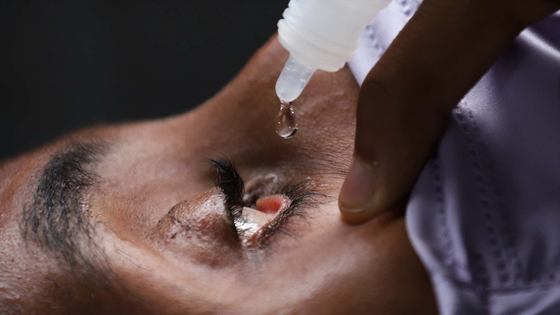 Gota de un colirio a punto de entrar en el ojo de una paciente