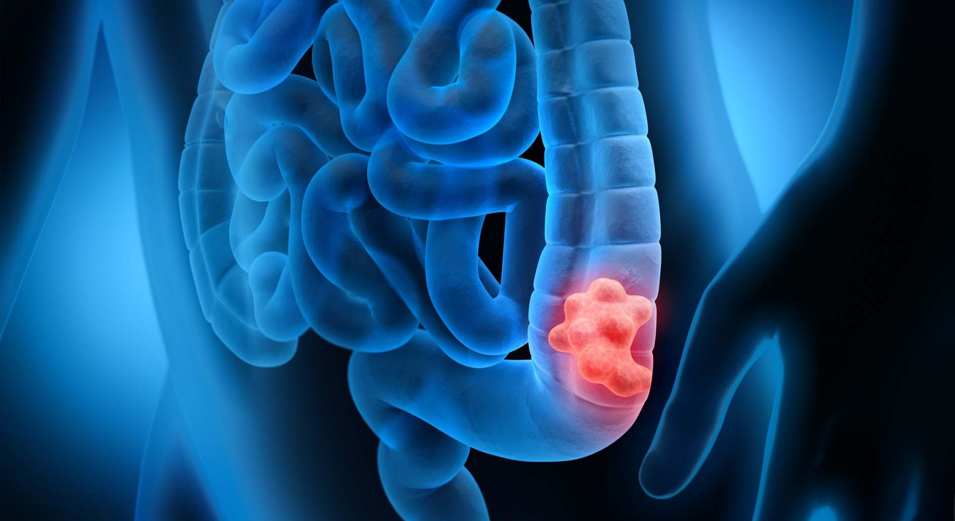 Cáncer colorrectal