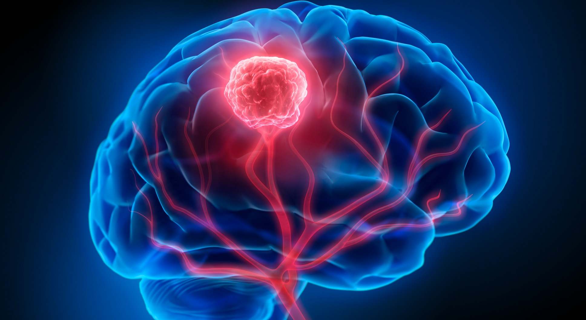 Tumor cerebral