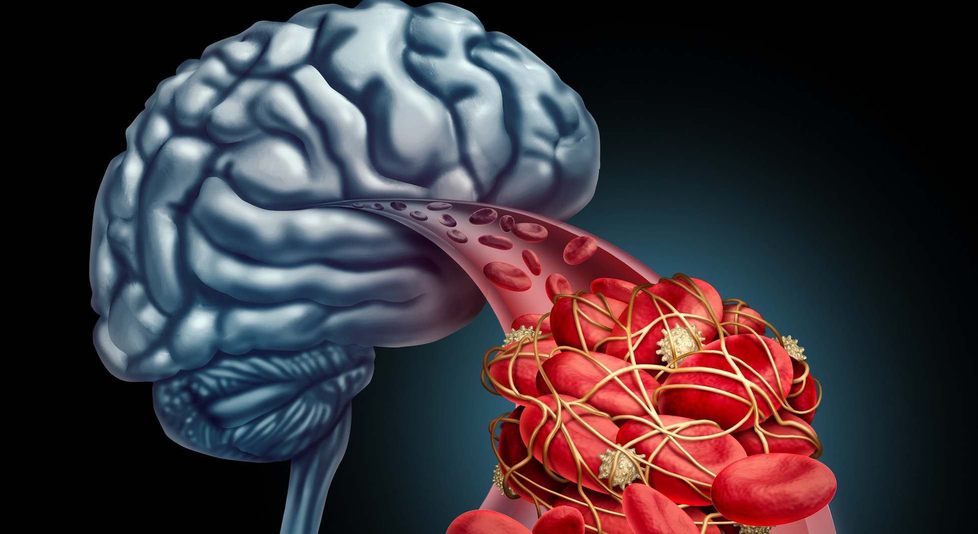 Ilustración 3D de un coágulo sanguíneo cerebral
