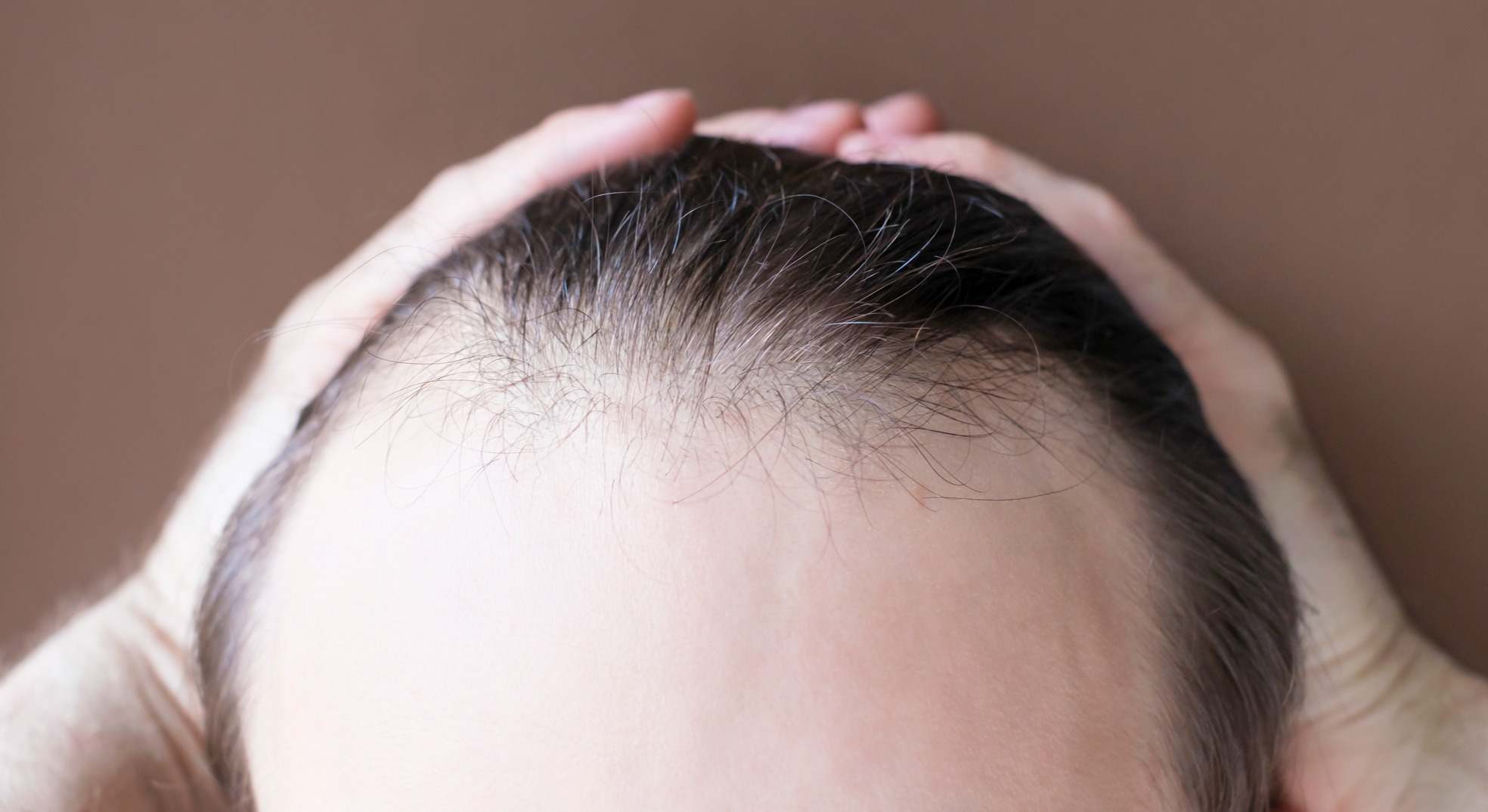 Persona con alopecia