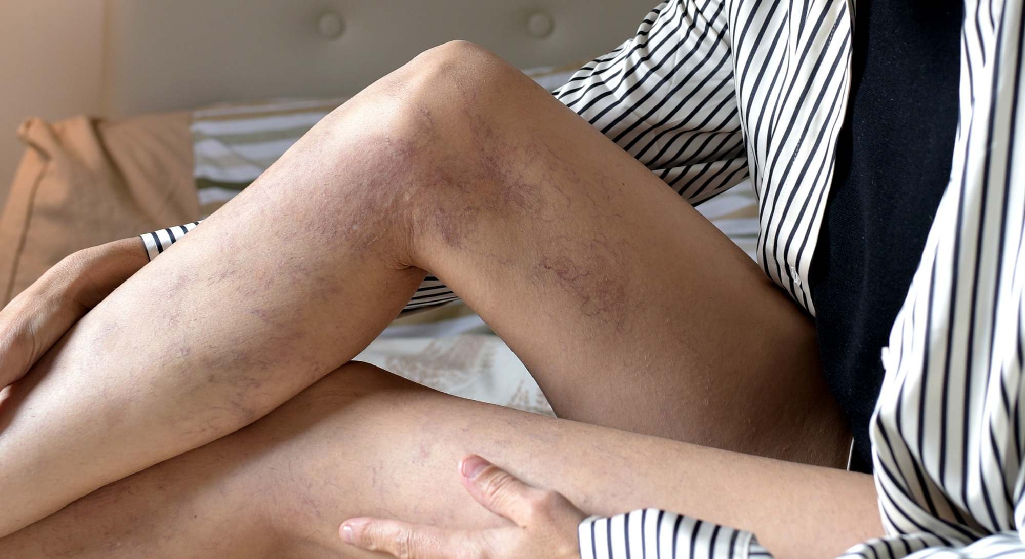 Mujer con varices en las piernas