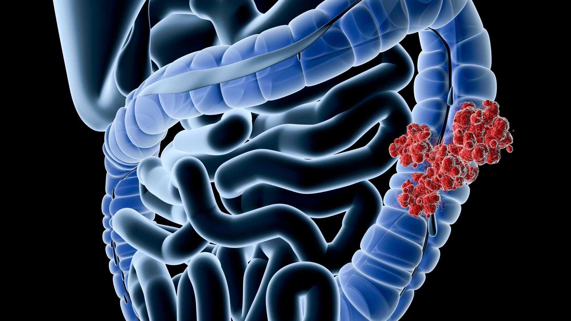 Ilustración 3D de un cáncer de colon