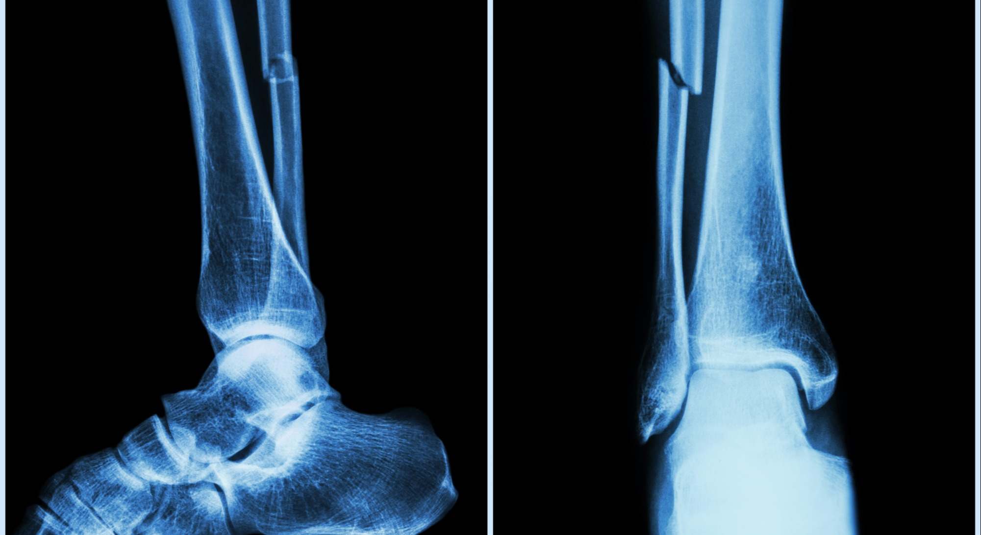 Radiografía de una fractura de peroné