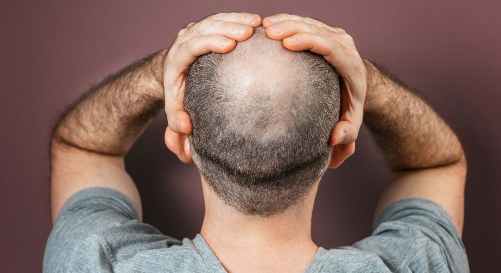 Hombre con alopecia
