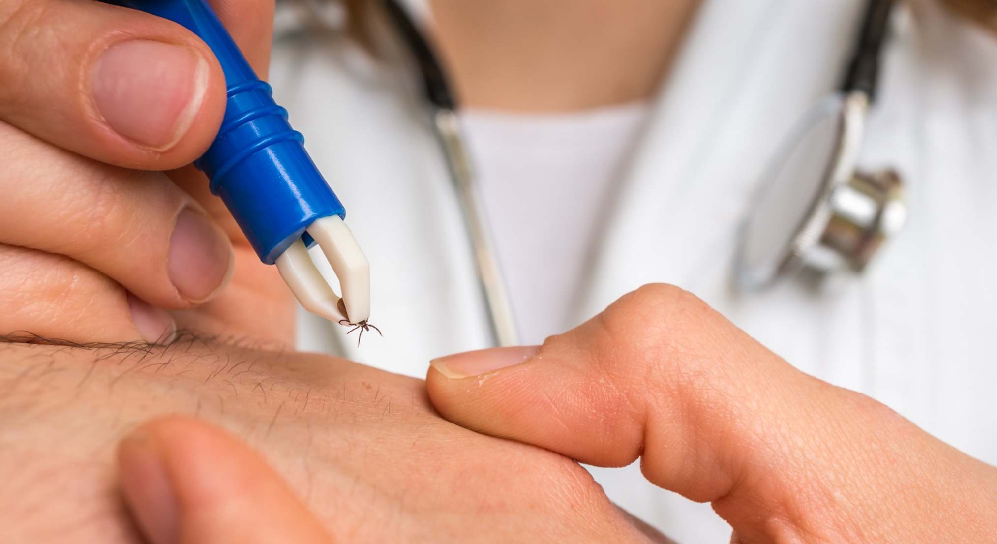 Doctor extrayendo una garrapata de un paciente con unas pinzas