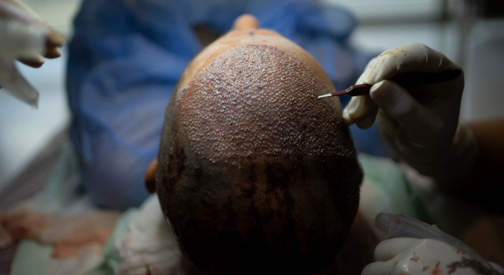 Hombre durante un trasplante de pelo