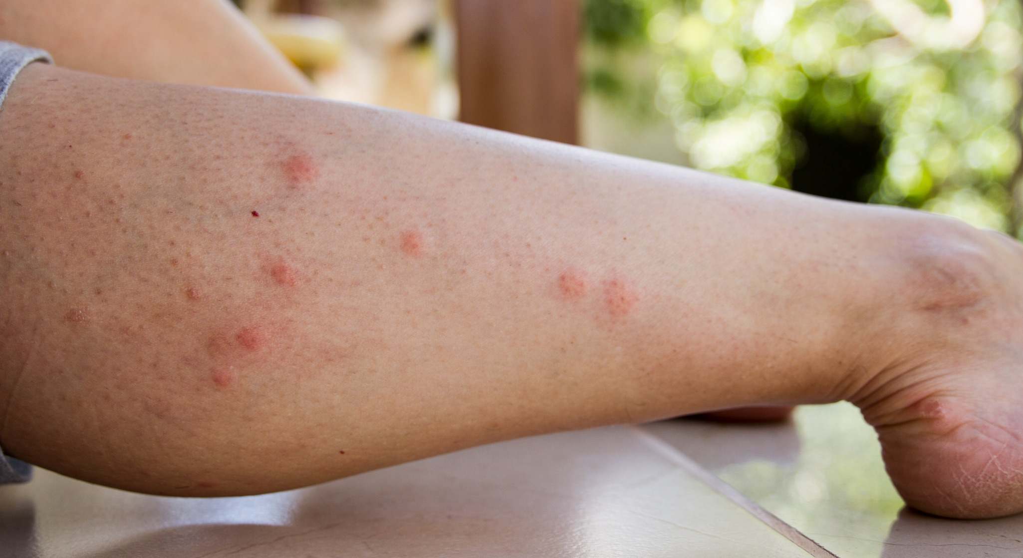 Pierna con gran cantidad de picaduras de mosquito
