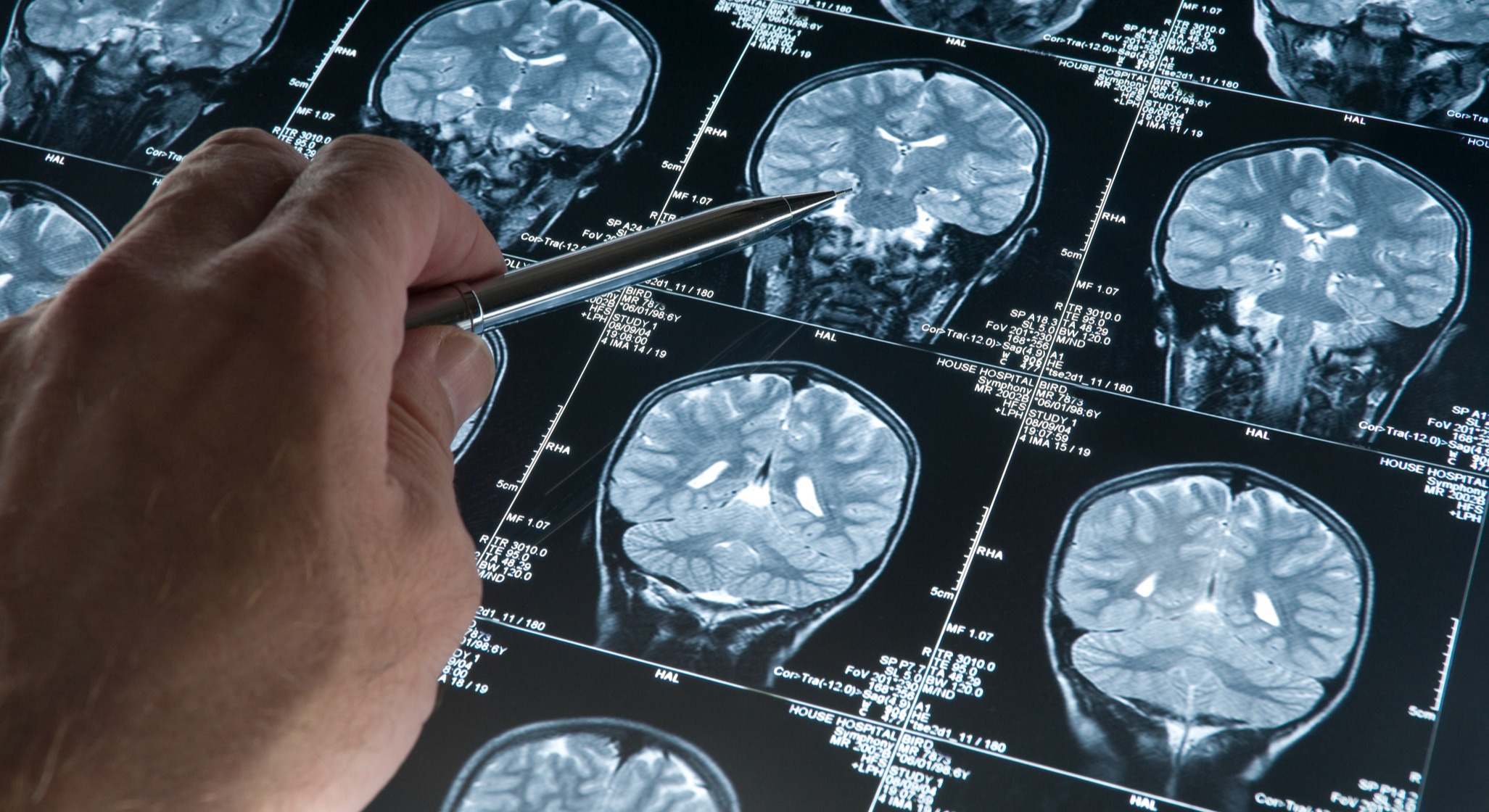 Radiografía de la cabeza y el cerebro