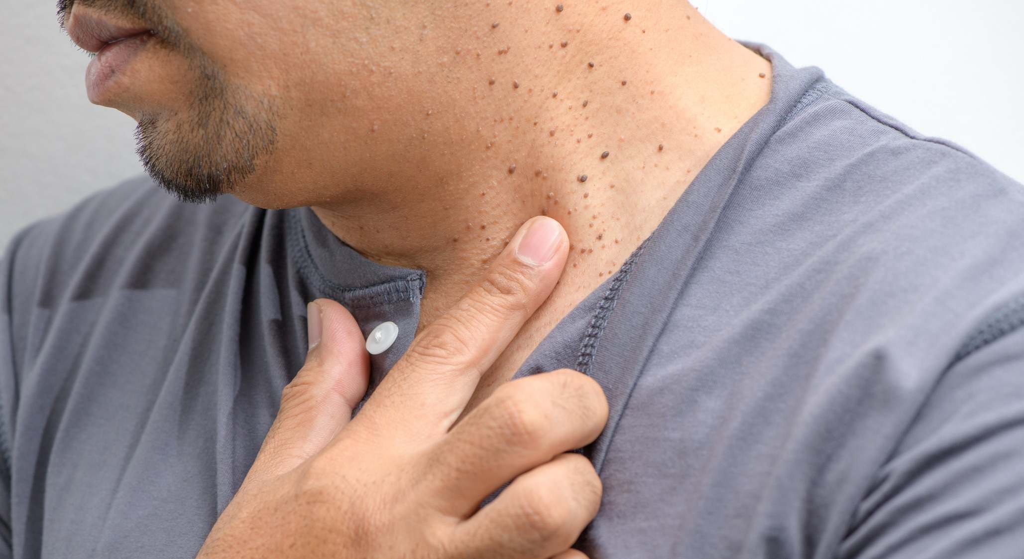 Hombre con verrugas en el cuello