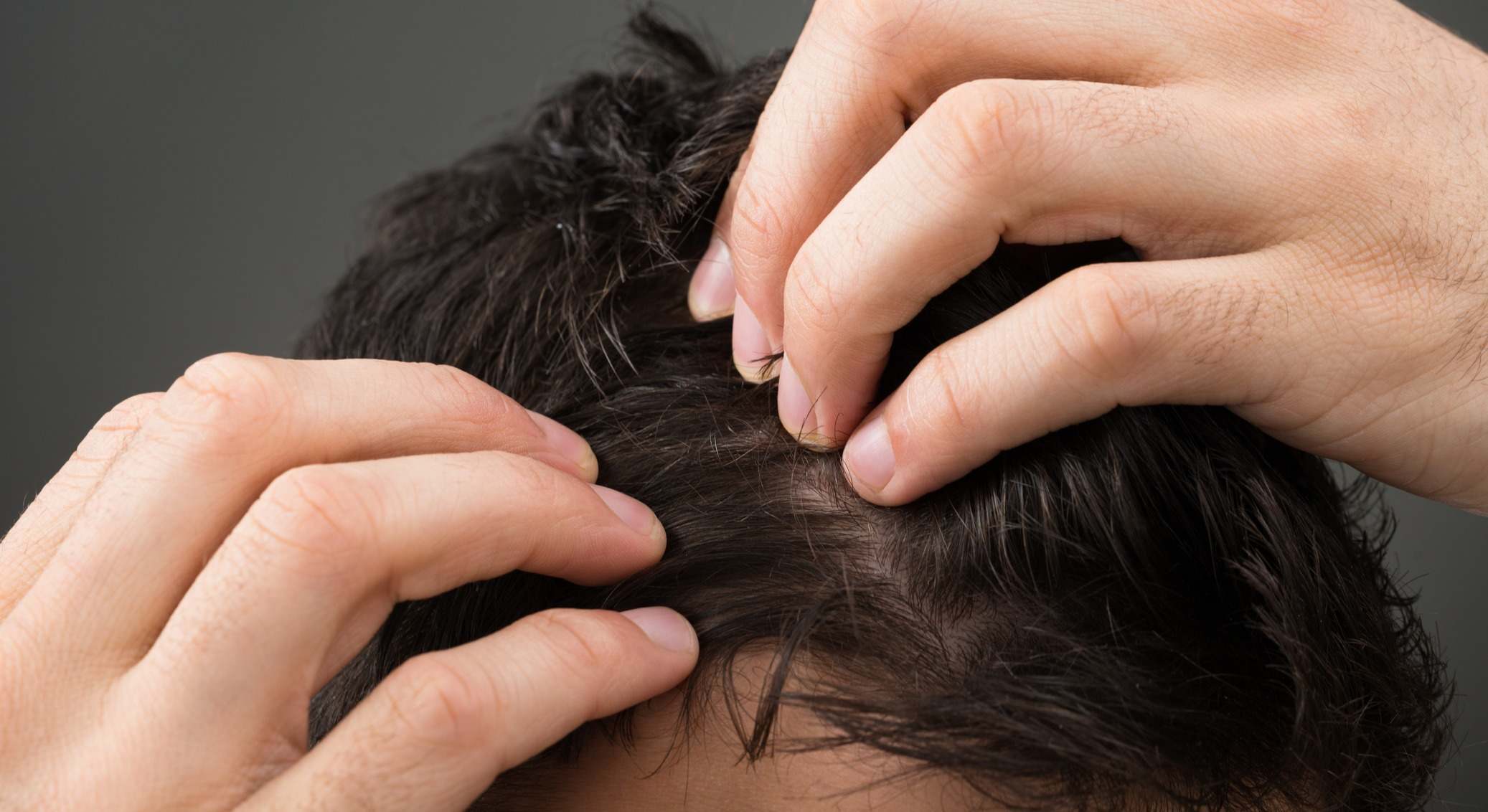 Hombre con problemas de caída de cabello