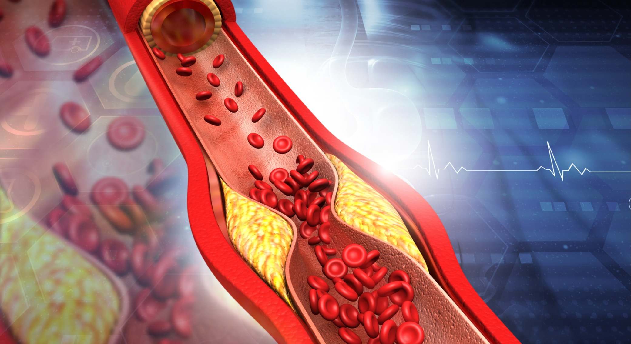 Ilustración 3D de arterias obstruidas, placa de colesterol en la arteria