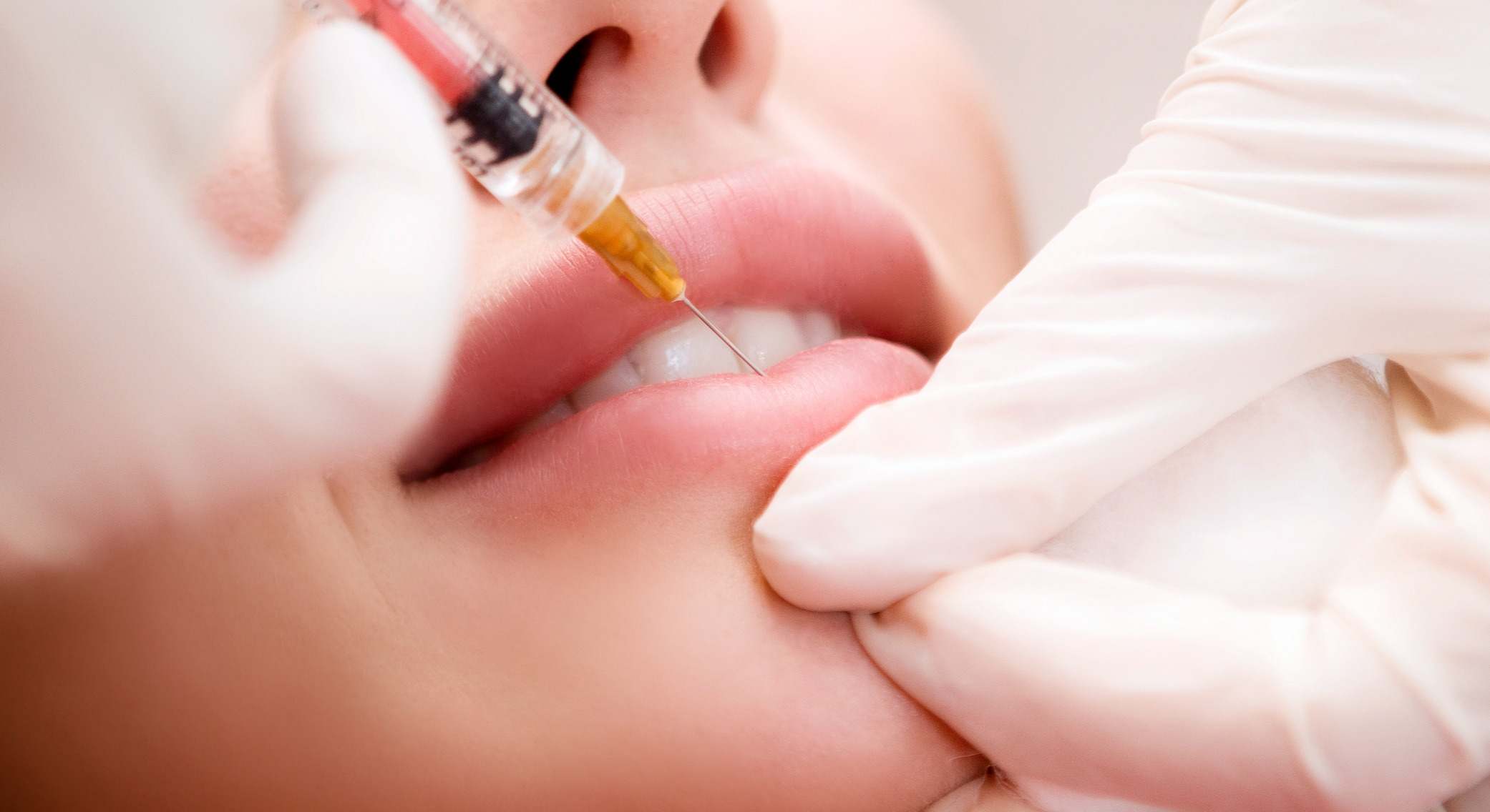 Labios con ácido hialurónico