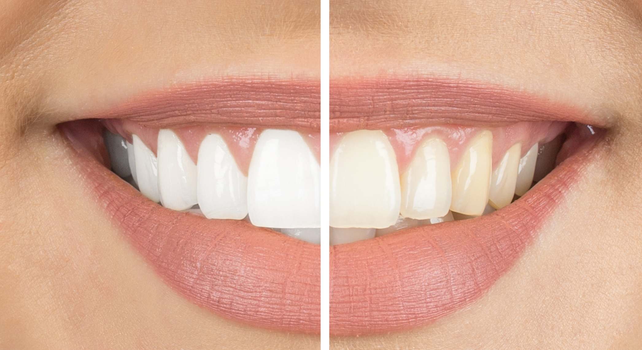 Dientes blancos antes y después