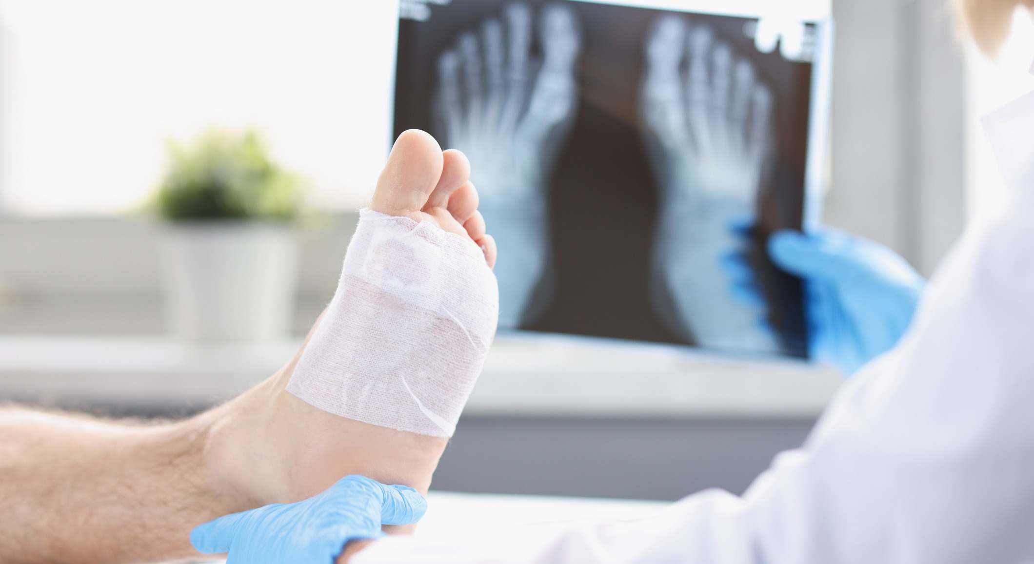 Fractura en el dedo de un pie y vendaje. / Foto: iStock